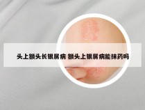 头上额头长银屑病 额头上银屑病能抹药吗