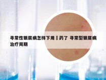 寻常性银屑病怎样下用抺药了 寻常型银屑病治疗周期