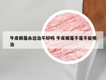 牛皮癣是永远治不好吗 牛皮癣是不是不能根治