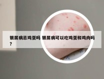 银屑病忌鸡蛋吗 银屑病可以吃鸡蛋和鸡肉吗?