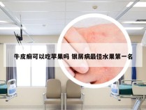 牛皮癣可以吃苹果吗 银屑病最佳水果第一名