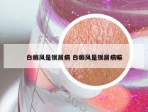 白癜风是银屑病 白癜风是银屑病嘛