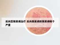 反向型银屑病治疗 反向银屑病和银屑病哪个严重