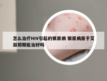 怎么治疗HIV引起的银屑病 银屑病属于艾滋初期能治好吗