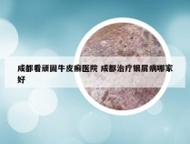 成都看顽固牛皮癣医院 成都治疗银屑病哪家好