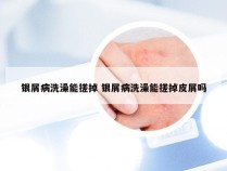 银屑病洗澡能搓掉 银屑病洗澡能搓掉皮屑吗