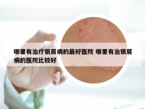 哪里有治疗银屑病的最好医院 哪里有治银屑病的医院比较好