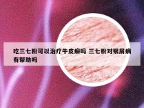 吃三七粉可以治疗牛皮癣吗 三七粉对银屑病有帮助吗