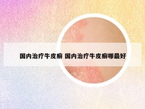 国内治疗牛皮癣 国内治疗牛皮癣哪最好