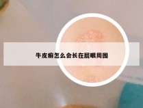 牛皮癣怎么会长在屁眼周围