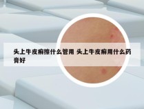 头上牛皮癣擦什么管用 头上牛皮癣用什么药膏好