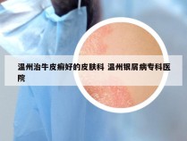 温州治牛皮癣好的皮肤科 温州银屑病专科医院
