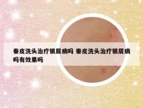 秦皮洗头治疗银屑病吗 秦皮洗头治疗银屑病吗有效果吗