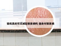 锻炼真的可以减轻银屑病吗 健身对银屑病