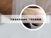 下身会长牛皮癣吗 下体长银屑病