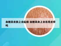 血糖高皮肤上会起癣 血糖高身上会出现皮疹吗