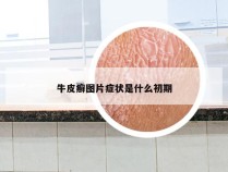 牛皮癣图片症状是什么初期