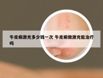 牛皮癣激光多少钱一次 牛皮癣做激光能治疗吗