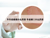 牛牛皮癣用什么药膏 牛皮癣抺什么药膏