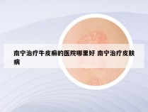 南宁治疗牛皮癣的医院哪里好 南宁治疗皮肤病