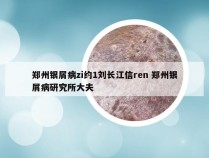 郑州银屑病zi约1刘长江信ren 郑州银屑病研究所大夫