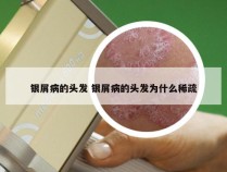 银屑病的头发 银屑病的头发为什么稀疏