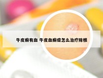 牛皮癣有血 牛皮血癣症怎么治疗除根