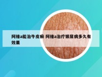 阿维a能治牛皮癣 阿维a治疗银屑病多久有效果