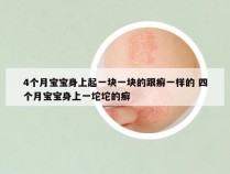 4个月宝宝身上起一块一块的跟癣一样的 四个月宝宝身上一坨坨的癣