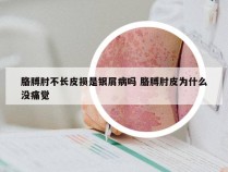 胳膊肘不长皮损是银屑病吗 胳膊肘皮为什么没痛觉