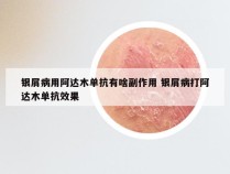 银屑病用阿达木单抗有啥副作用 银屑病打阿达木单抗效果