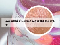 牛皮癣到底怎么能治好 牛皮癣到底怎么能治好