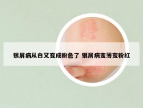 银屑病从白又变成粉色了 银屑病变薄变粉红