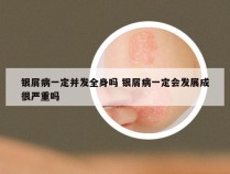 银屑病一定并发全身吗 银屑病一定会发展成很严重吗