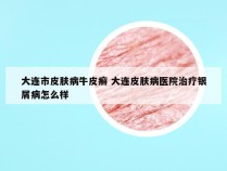 大连市皮肤病牛皮癣 大连皮肤病医院治疗银屑病怎么样