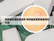 如何避免银屑病遗传 如何避免银屑病遗传给小孩