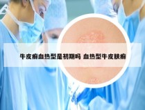 牛皮癣血热型是初期吗 血热型牛皮肤癣