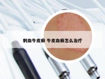 刺血牛皮癣 牛皮血癣怎么治疗