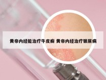 黄帝内经能治疗牛皮癣 黄帝内经治疗银屑病