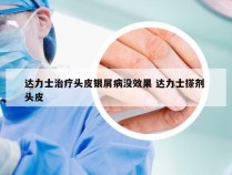 达力士治疗头皮银屑病没效果 达力士搽剂 头皮