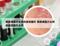 银屑病是什么样的症状图片 银屑病是什么样的症状图片女性
