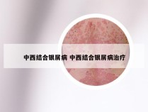 中西结合银屑病 中西结合银屑病治疗