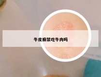 牛皮癣禁吃牛肉吗