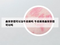 曲安奈德可以治牛皮癣吗 牛皮癣用曲安奈德可以吗