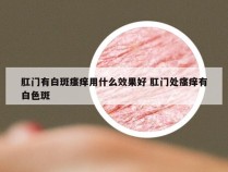 肛门有白斑瘙痒用什么效果好 肛门处瘙痒有白色斑