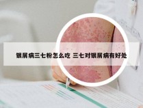 银屑病三七粉怎么吃 三七对银屑病有好处