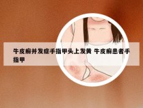 牛皮癣并发症手指甲头上发黄 牛皮癣患者手指甲