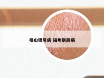 福山银屑病 福州银屑病