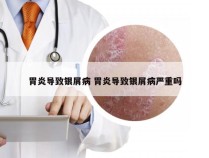胃炎导致银屑病 胃炎导致银屑病严重吗