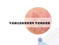 牛皮癣过滤血液有用吗 牛皮癣血液病